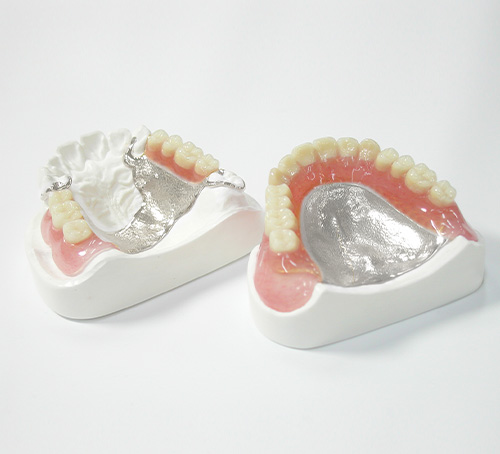 入れ歯の種類02_金属床義歯